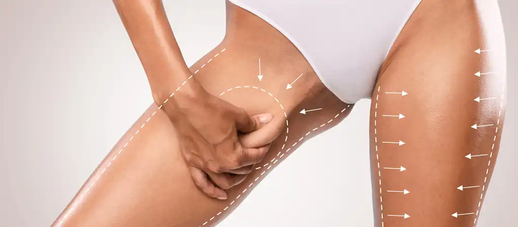 Combplasztikai műtét előtti sebészeti jelölések női páciens combján.